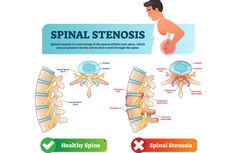 Stenosis Spinal (Tulang Belakang)