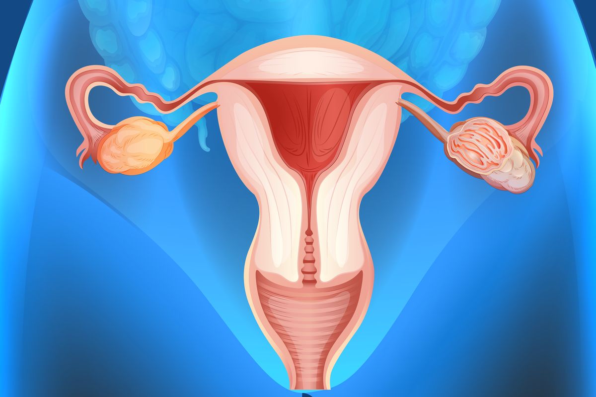 Ilustrasi ovarium. Kanker ovarium terjadi ketika sel-sel berkembang biak dengan cepat tak terkendali di ovarium. 