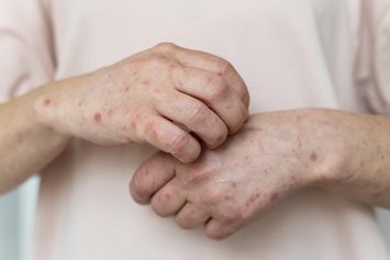 Rangkaian Cara Membunuh Kutu Scabies yang Ampuh untuk Mencegah Terjadinya Infeksi pada Kulit