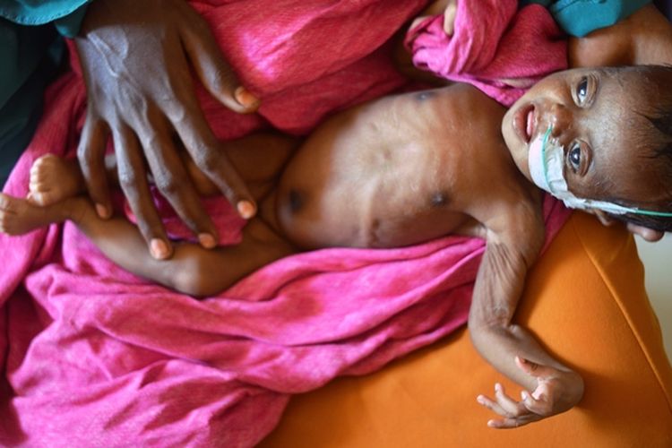 Seorang bayi yang kekurangan gizi bersama ibunya menunggu untuk mendapatkan penanganan di sebuah rumah sakit di kota Baidoa, Somalia.