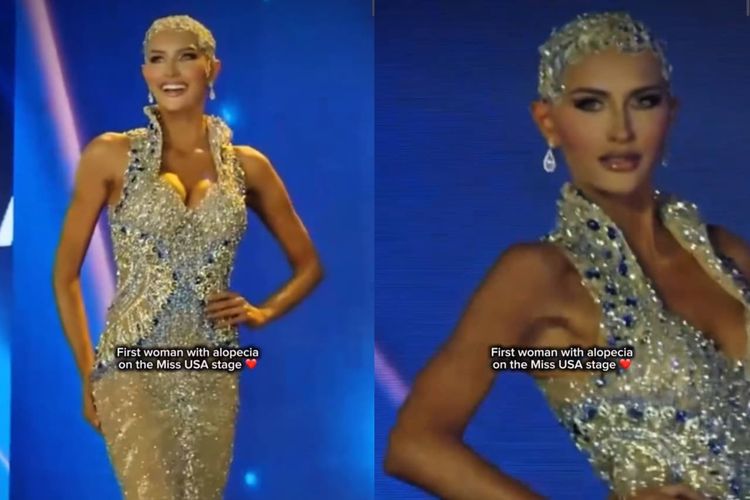 Miss Nevada 2025, Mary Sickler, yang merupakan kontestan Miss USA pertama yang tampil botak karena mengidap penyakit alopecia.