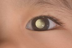 Retinoblastoma