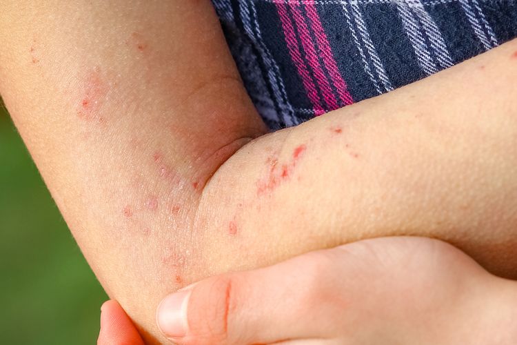Ilustrasi alergi pada kulit.