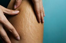 10 Cara Menghilangkan Stretch Mark di Paha