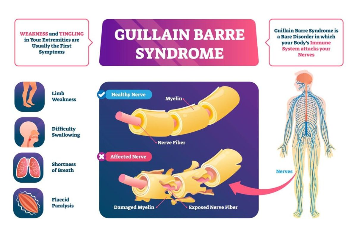 Ilustrasi Sindrom Guillain Barre