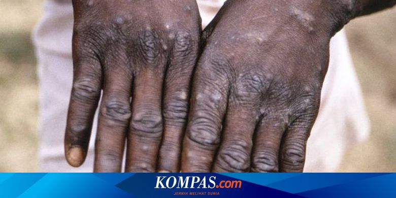 Cacar Monyet, Penyakit Langka Ini Muncul Lagi di Amerika Serikat - Vimarsana News