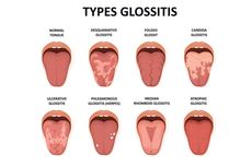 Glositis