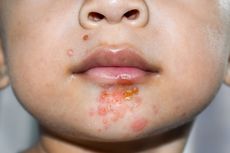 Impetigo