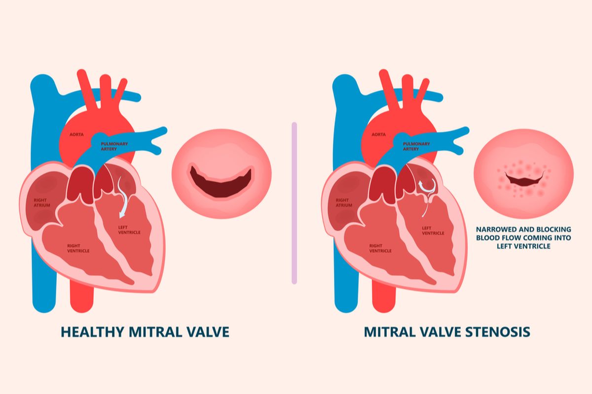 ilustrasi stenosis mitral