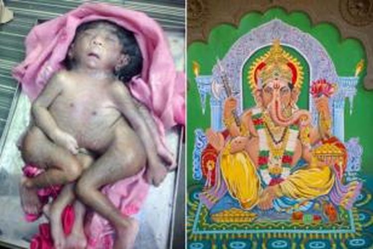 Seorang bayi di India terlahir dengan empat tangan dan kaki justru dianggap sebagai titisan Dewa Ganesha,
