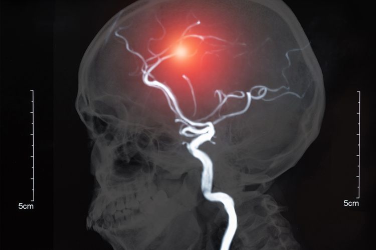 Ilustrasi aneurisma otak. Aneurisma otak adalah tonjolan di area arteri yang lemah di dalam atau di sekitar otak Anda. Sangat mengancam jiwa, jika aneurisma ini pecah.