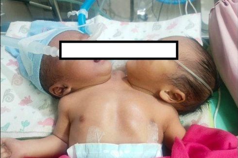 Bayi Kembar Siam Lahir di Pulogadung Jaktim, Begini Kondisinya…