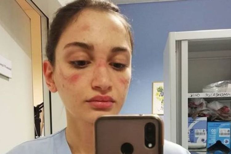 Dalam foto yang diunggah di Instagram, seorang perawat di Italia bernama Alessia Bonari menunjukkan mukanya yang memar karena mengenakan masker wajah, di tengah perjuangannya merawat pasien virus corona.