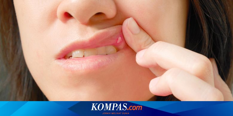 Luka Di Mulut Belum Tentu Sariawan Kenali Ciri Cirinya