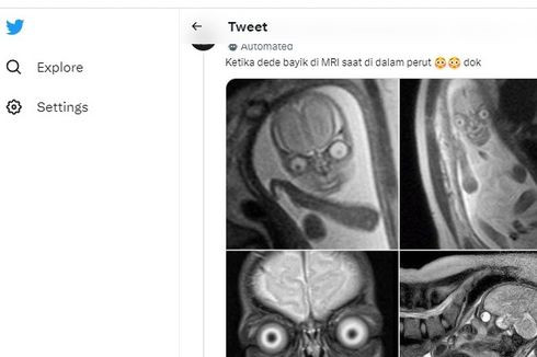 Bolehkah Wanita Hamil Melakukan Pemeriksaan MRI? 