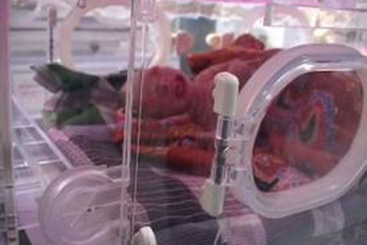 Bayi tanpa selaput kulit luar disimpan di dalam inkubator di RSU Kolaka, Senin (31/3/2014).