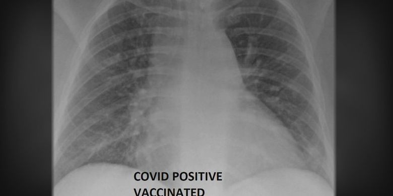 Foto rontgen pasien Covid-19 yang sudah divaksinasi. Foto menunjukkan paru-paru masih memiliki banyak area hitam, yang artinya masih dipenuhi oksigen.