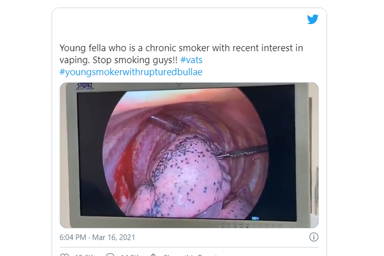 Tangkapan layar video yang menyebut bintik hitam pada paru-paru.