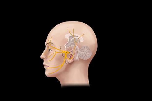 Trigeminal Neuralgia, Nyeri Paling Ngeri yang Menyerang Wajah Manusia