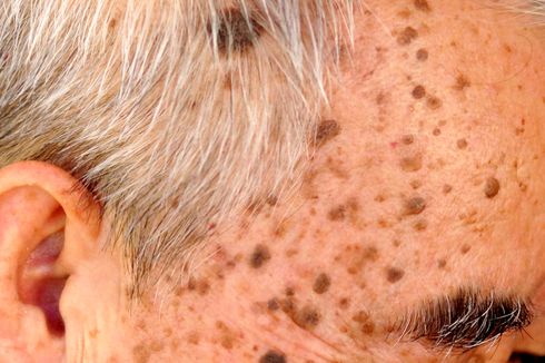 Keratosis Seboroik