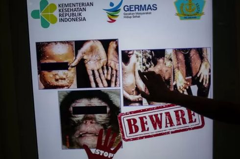 Waspada Virus Monkeypox, Kenali Gejalanya