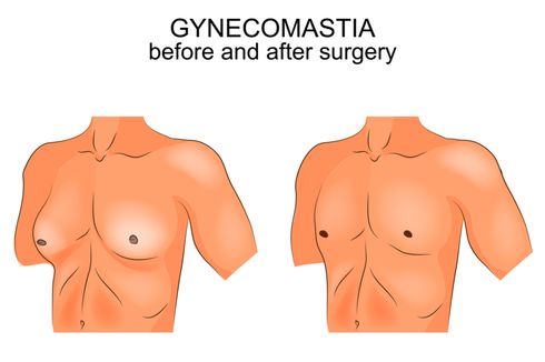 Pembesaran Payudara pada Pria (Ginekomastia)