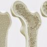 Cara Mencegah Osteoporosis yang Penting Dilakukan Sebelum Terlambat