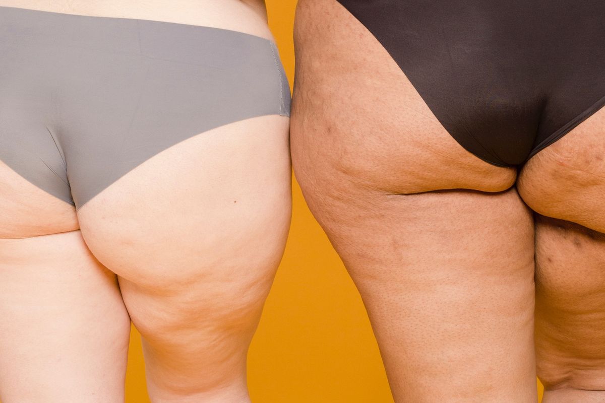 Selulit adalah jaringan lemak berwarna putih yang umumnya muncul di paha, pinggul, dan bokong.