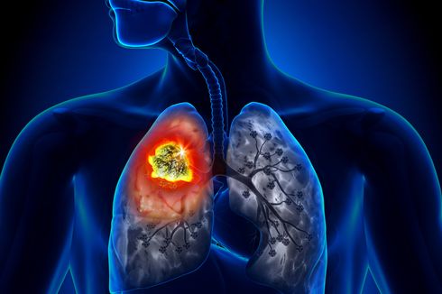 5 Penyebab Kanker Paru-paru, Tak Hanya Rokok
