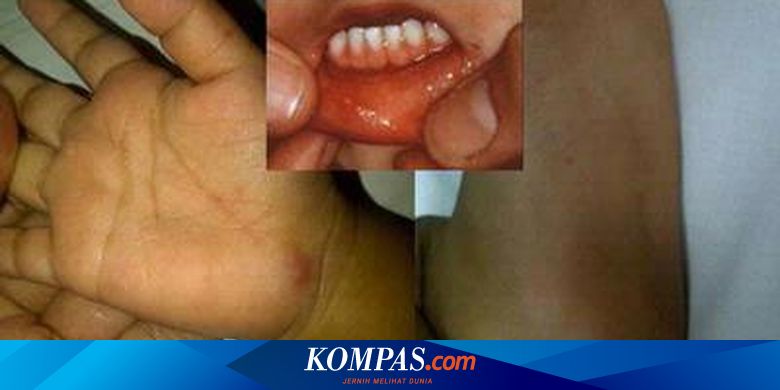Balita Jakarta Terancam Wabah Flu Singapura Halaman All Kompas Com