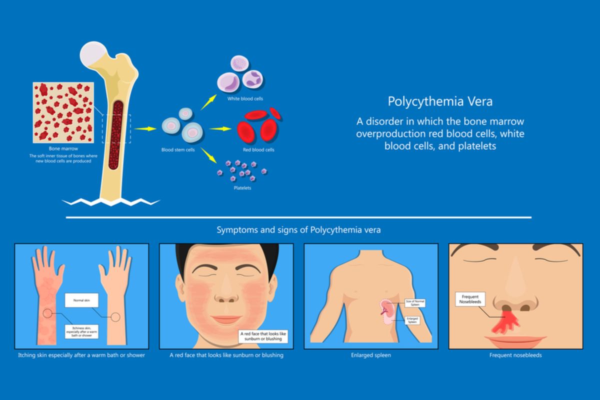 Ilustrasi polisitemia vera