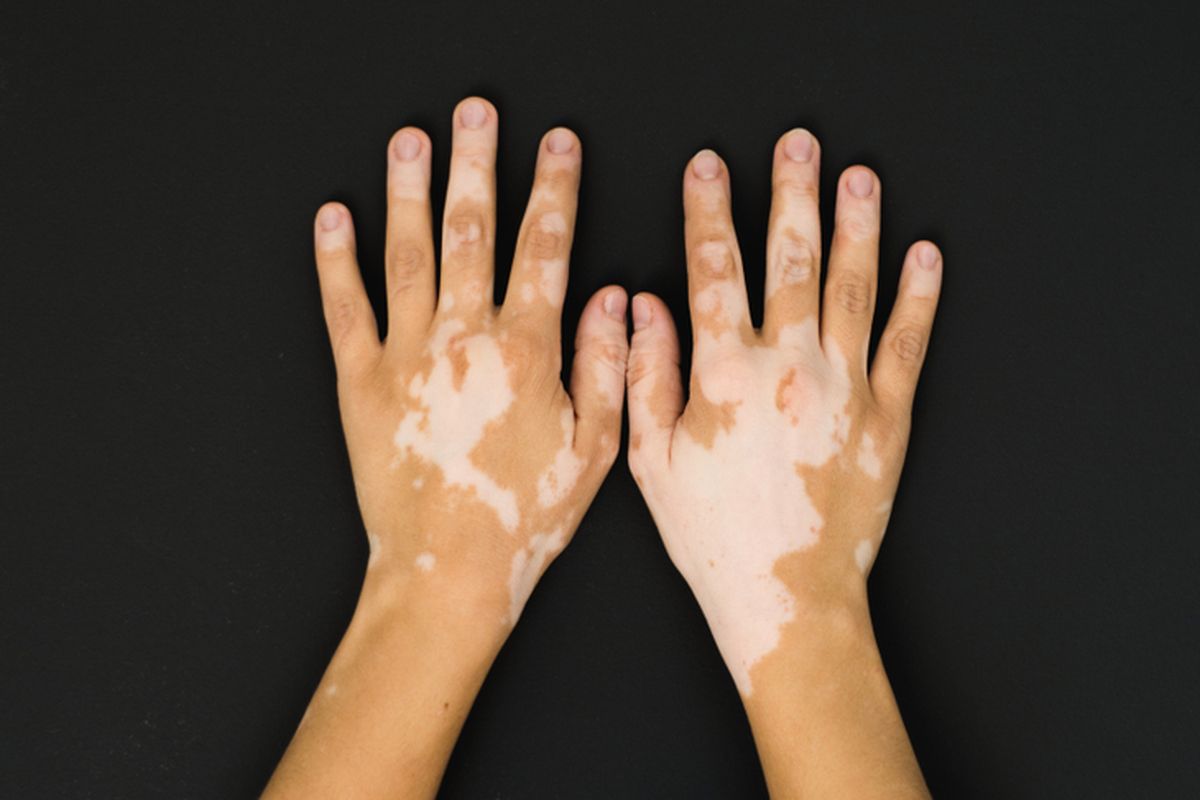 Ilustrasi penyakit kulit vitiligo.