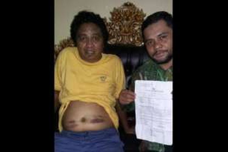 Pelawak Amoy menunjukkan bekas luka memar yang diduga akibat sabetan parang Master Fakir Limbad.