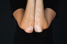 Kenali Apa itu Vitiligo, Bercak Putih pada Kulit Tapi Bukan Panu