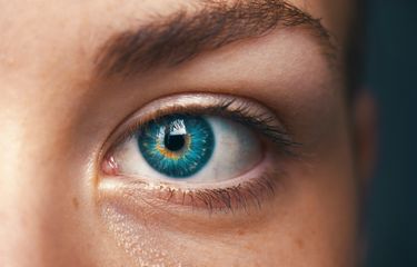 Ilustrasi heterochromia parsial.