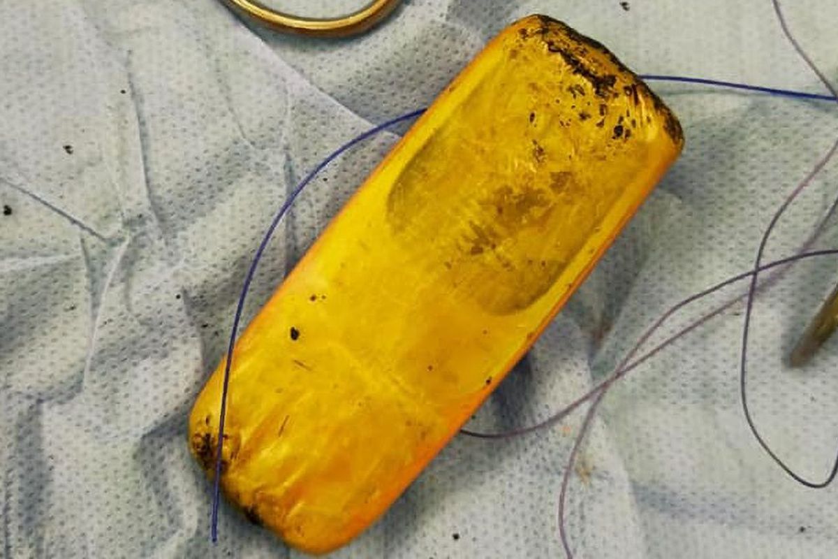 Ponsel yang ditelan seorang pria di Aswan, Mesir. Dokter mengaku terkejut saat pria itu datang karena mengeluh sakit perut.