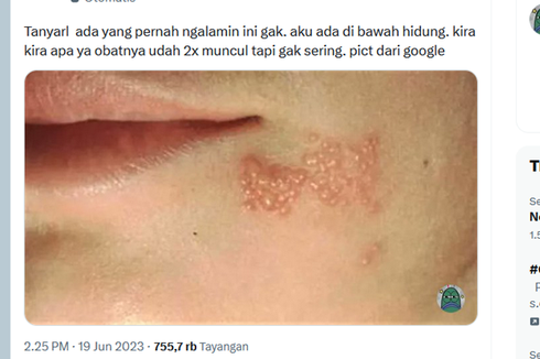 Muncul Bintik-bintik Berair di Bawah Hidung? Kenali Penyebab dan Penanganan Herpes Labialis