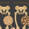 Osteomalasia