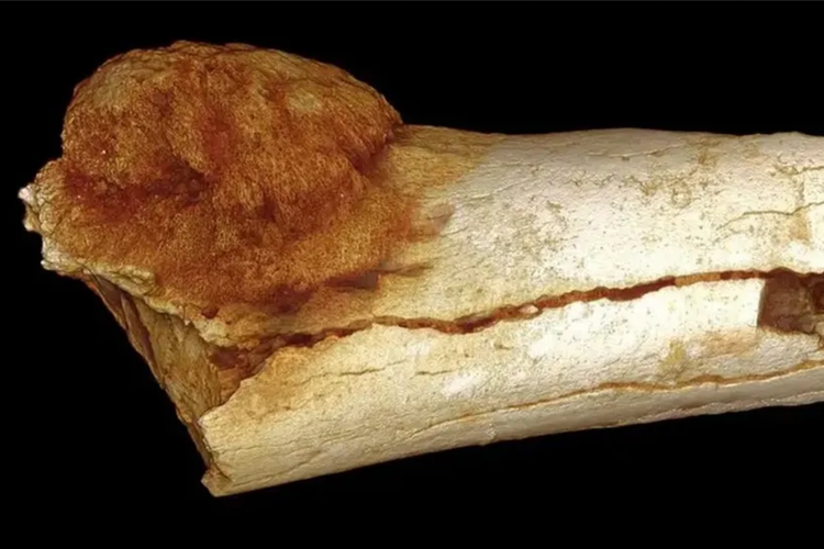 Kasus kanker pertama yang tercatat terjadi 1,7 juta tahun lalu ditemukan di tulang jari kaki manusia purba 