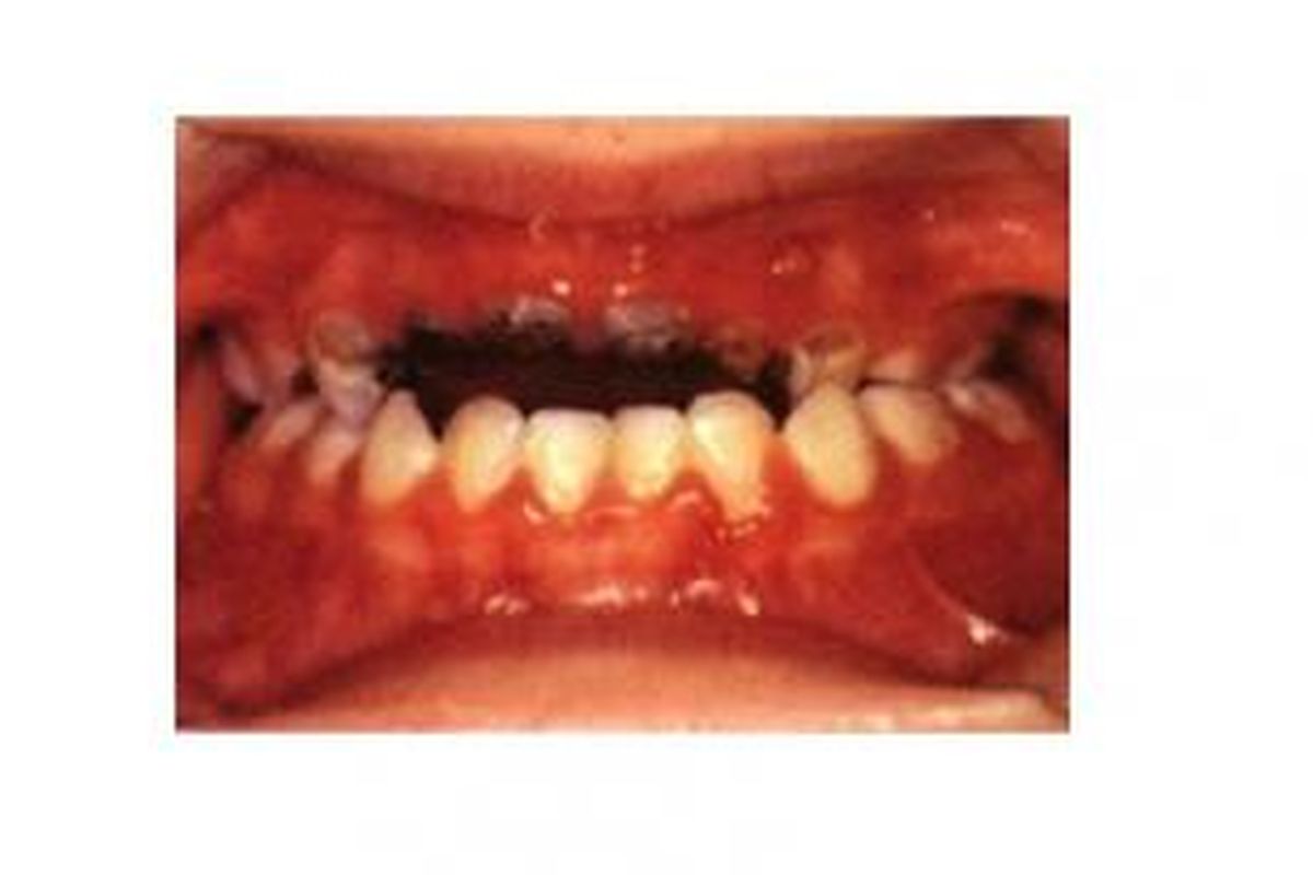 Karies botol pada anak yang rata gusi pada gigi depan atas