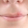Bibir Melepuh