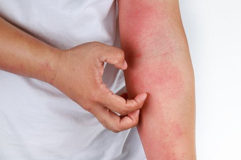 Kenali Apa itu Dermatitis, Jenis, dan Penyebabnya