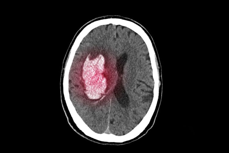 Faktor Risiko Stroke Pendarahan Otak yang Pantang Disepelekan
