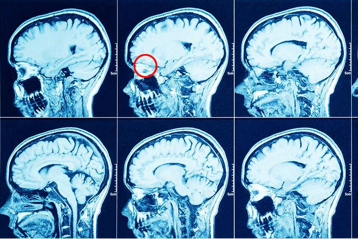 Ilustrasi hasil pemindaian MRI otak. Bagian yang dilingkari merah adalah area saraf penciuman.