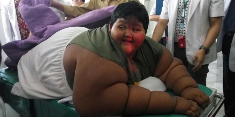 Arya Permana (10) penderita severe obesity ditangani 13 dokter spesialis RSHS. Berat badan normal Arya kurang dari 50 kg, namun saat ini beratnya mencapai 189,5 kg. 