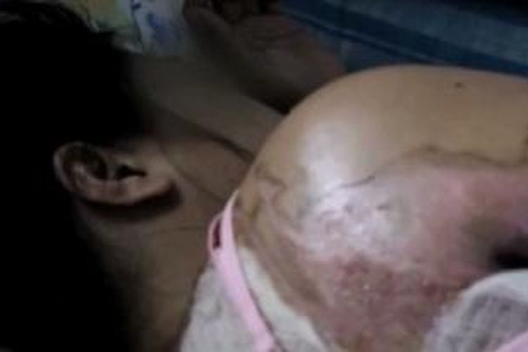 Salah satu foto dari Pahima Alagai Palacasi, PRT asal Filipina yang mengalami penyiksaan di Arab Saudi