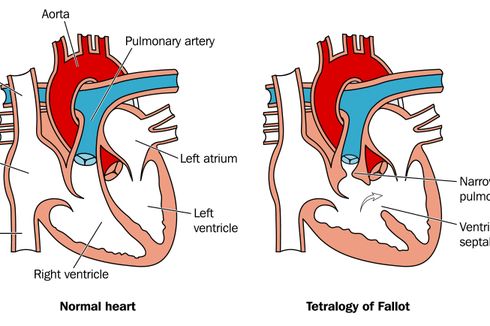 Tetralogy of Fallot (TOF)