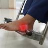 Penyebab Luka di Kaki Pasien Diabetes Susah Sembuh