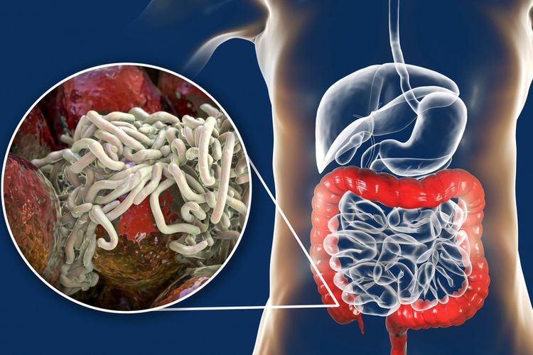 Ilustrasi infeksi cacing kremi
