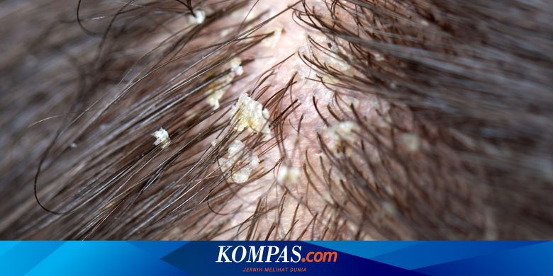 Mendadak Alami Ketombe? Awas, Bisa Jadi Penyebabnya Stres - Vimarsana News